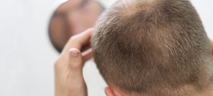 Motivos que causan caída del cabello